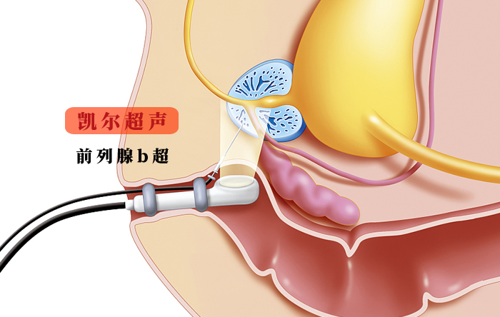 前列腺b超